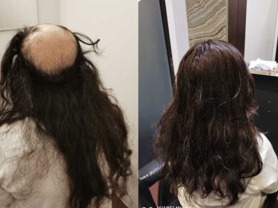 Hair Replacement Singapore