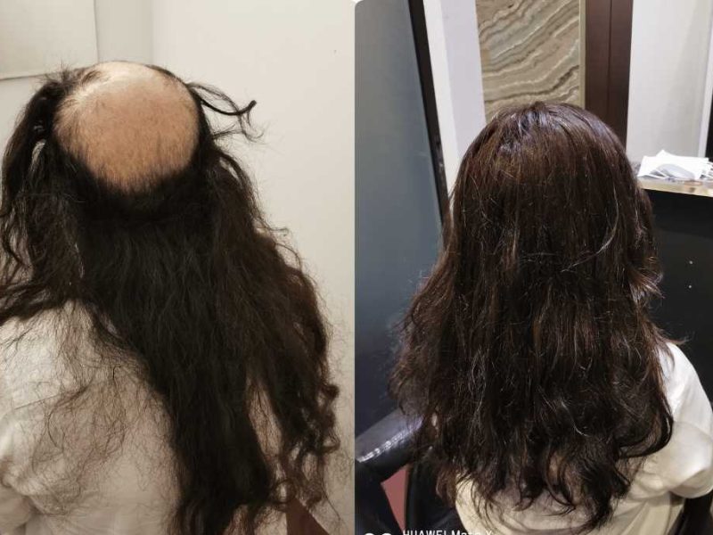 Hair Replacement Singapore