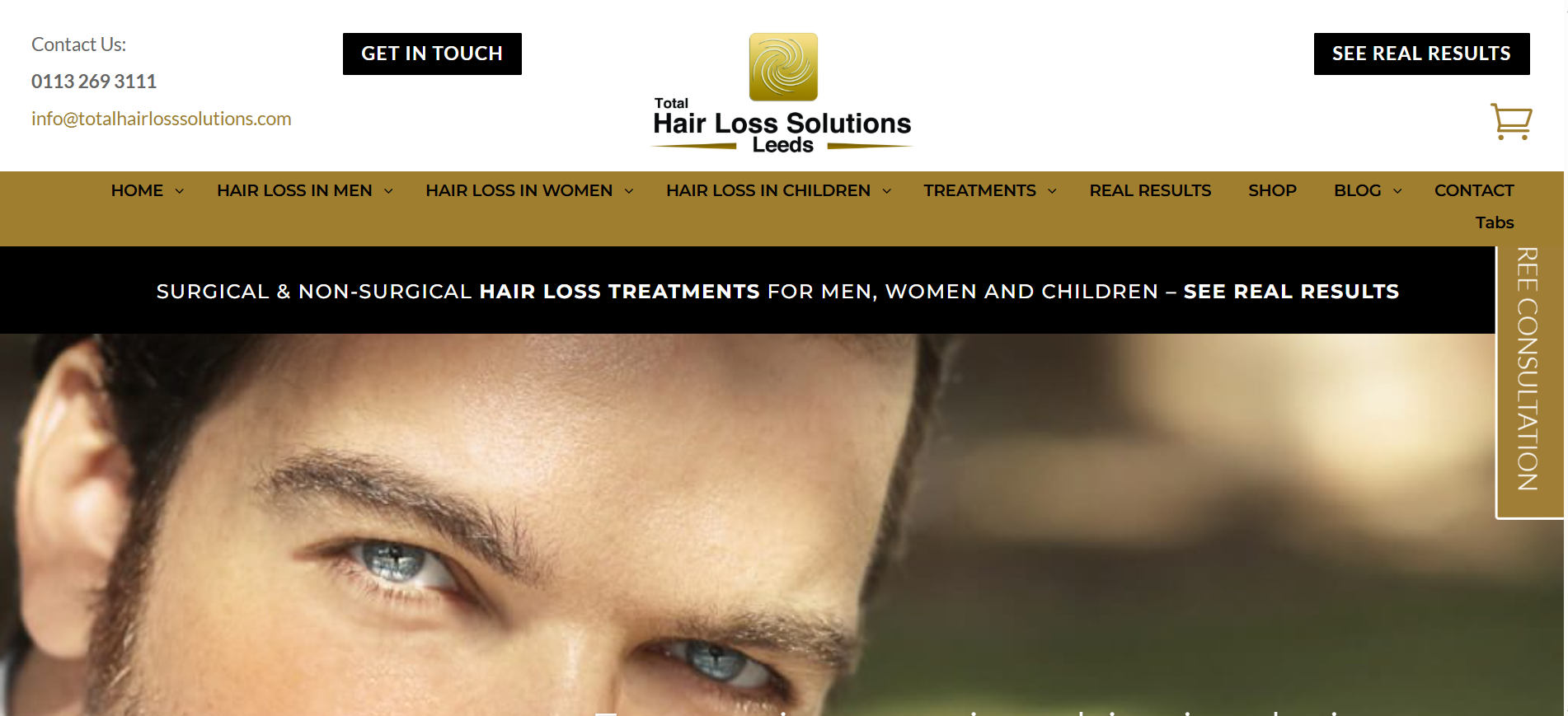 Hair Loss Treatment for Men in Yorkshire